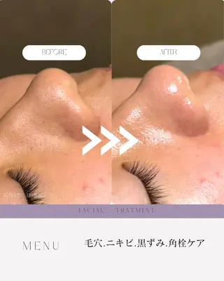 肌質改善✖️ 小顔｜Rikaのエステ・リラクイメージ