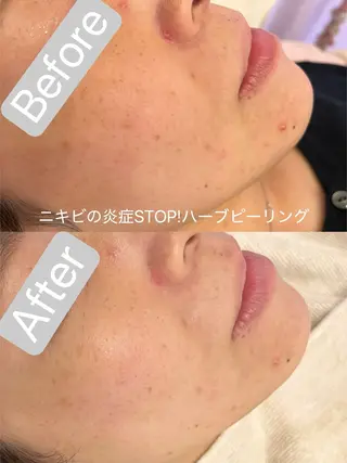 小顔&毛穴・肌質改善 LINDA西宮 AIのその他イメージ