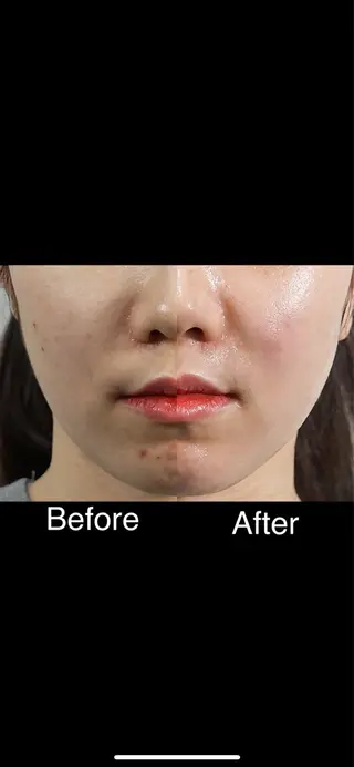 くすみ・シミ改善/ ララピール/光フォトのその他イメージ