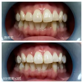 ネイル/耳つぼ /新ホワイトニングのネイルデザイン