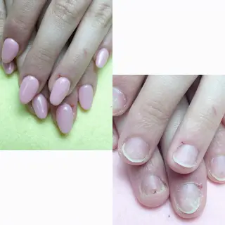 ネイル 深爪矯正/爪育成ケア manie nailのネイルデザイン
