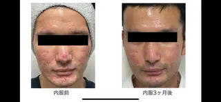 【赤ニキビ改善】 BELL'ET新宿店のエステ・リラクイメージ