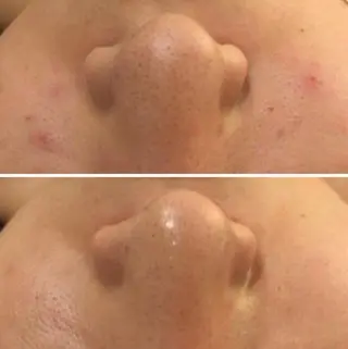 セミロング カラー パーマ ヘアアレンジ メンズ キッズ ネイル マツエク・マツパ アイブロウ 3か月で肌革命👼 ニキビ専門店💫のエステ・リラクイメージ