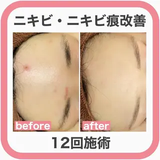 3か月で肌革命👼 ニキビ専門店💫のエステ・リラクイメージ