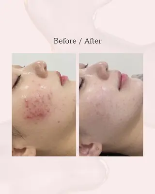 myherb所属・ニキビ肌改善 ハーブピーリング🌿のエステ・リラクイメージ