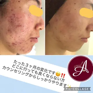 ミディアム カラー パーマ ヘアアレンジ メンズ キッズ ネイル マツエク・マツパ ニキビ・肌質改善専門 ♡人生が変わるサロンのエステ・リラクイメージ