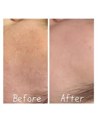 Charme coco(シャルム ココ)八尾店所属・ニキビ 毛穴ケア シャルム ココ みさのエステ・リラクイメージ