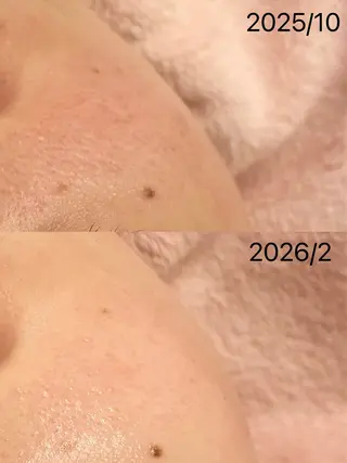 小顔&毛穴・肌質改善 LINDA西宮 AIのその他イメージ