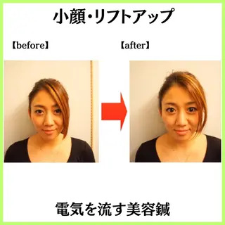 小顔ハーブピーリング 美容鍼/毛穴洗浄のエステ・リラクイメージ