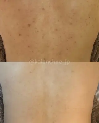 肌質改善 KALANCHOEのエステ・リラクイメージ