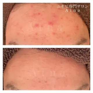セミロング カラー パーマ ヘアアレンジ メンズ キッズ ネイル マツエク・マツパ アイブロウ ニキビ跡専門サロン Ainaのエステ・リラクイメージ