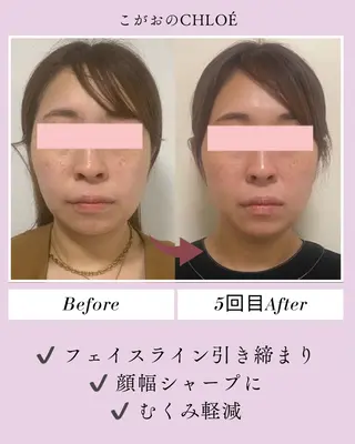 小顔サロン こがおのCHLOÉのエステ・リラクイメージ