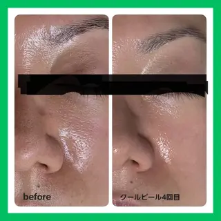 ニキビケア◇ニキビ跡 レゾン京橋店　峠山のエステ・リラクイメージ