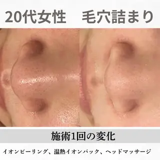 重度ニキビ専門🌷 ダウンタイムなしのエステ・リラクイメージ