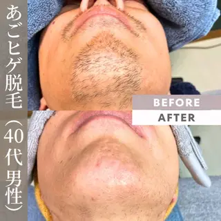 メンズ 【一本ずつ脱毛】 ReMove 柏のエステ・リラクイメージ