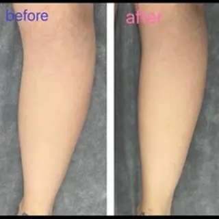 ハーブピーリング ララピール 田中のその他イメージ