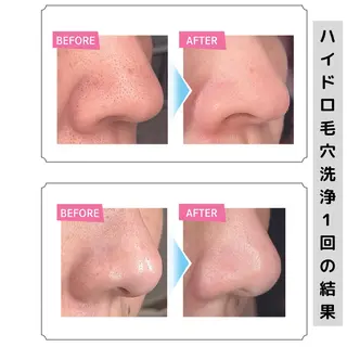 毛穴と美肌 littleroomのエステ・リラクイメージ