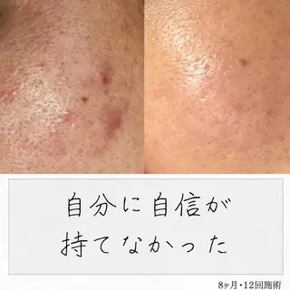 ニキビ経験者が施術 する専門サロン🌻のエステ・リラクイメージ