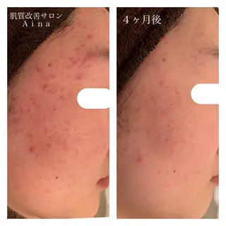 ミディアム カラー パーマ ヘアアレンジ メンズ キッズ ネイル マツエク・マツパ ニキビ跡専門サロン Ainaのエステ・リラクイメージ