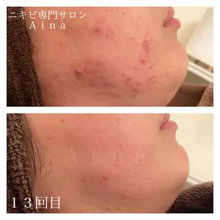 ロング カラー パーマ ヘアアレンジ メンズ キッズ ネイル マツエク・マツパ ニキビ跡専門サロン Ainaのエステ・リラクイメージ