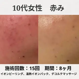 ニキビ跡改善専門🔥 医療にはできない改善のエステ・リラクイメージ