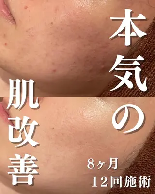 3か月で肌革命👼 ニキビ専門店💫のエステ・リラクイメージ