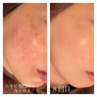セミロング カラー パーマ ヘアアレンジ メンズ キッズ ネイル マツエク・マツパ ニキビ跡専門サロン Ainaのエステ・リラクイメージ