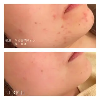ミディアム カラー パーマ ヘアアレンジ メンズ キッズ ネイル マツエク・マツパ ニキビ跡専門サロン Ainaのエステ・リラクイメージ