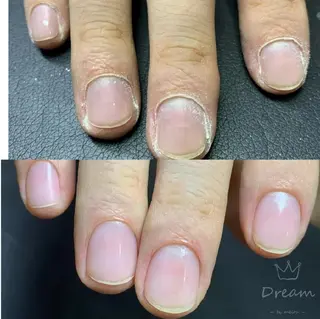 ショート ネイル フィルイン・深爪矯正 長さ出し🎀のネイルデザイン