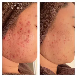 セミロング パーマ ヘアアレンジ メンズ キッズ ネイル マツエク・マツパ アイブロウ ニキビ跡専門サロン Ainaのエステ・リラクイメージ
