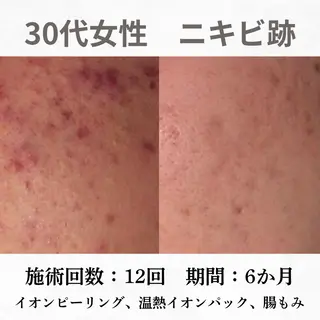 重度ニキビ専門🌷 ダウンタイムなしのエステ・リラクイメージ