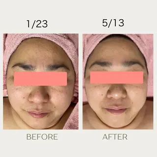 ピーリングケア 🤍moekoのその他イメージ