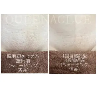 毛穴改善/脱毛 ネイル　川上久仁子のエステ・リラクイメージ