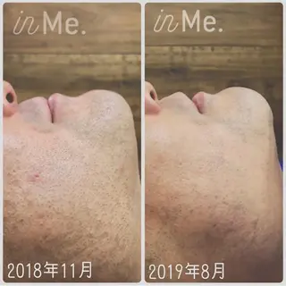 メンズ ◆つど払い脱毛◆ in Me.インミーのエステ・リラクイメージ