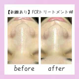 ニキビ 毛穴ケア シャルム ココ みさのエステ・リラクイメージ