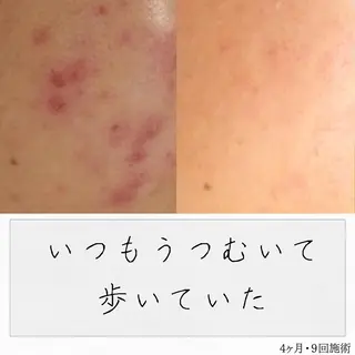 ニキビ経験者が施術 する専門サロン🌻のエステ・リラクイメージ