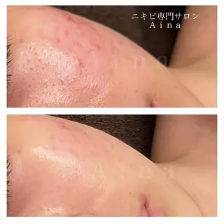 セミロング パーマ ヘアアレンジ メンズ キッズ ネイル マツエク・マツパ アイブロウ ニキビ跡専門サロン Ainaのエステ・リラクイメージ