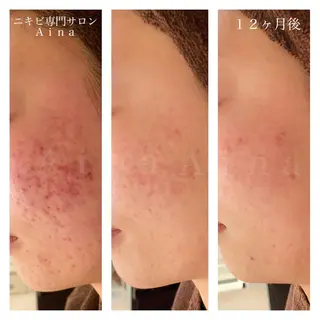 セミロング パーマ ヘアアレンジ メンズ キッズ ネイル マツエク・マツパ ニキビ跡専門サロン Ainaのエステ・リラクイメージ