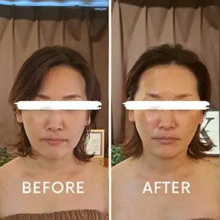 鍼灸サロンmiyabi所属・美容鍼×エステ　鍼灸 サロンmiyabiのエステ・リラクイメージ