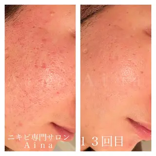 セミロング カラー パーマ ヘアアレンジ メンズ キッズ ネイル マツエク・マツパ ニキビ跡専門サロン Ainaのエステ・リラクイメージ
