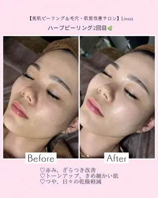 メンズ Mr.&Ms.脱毛/ ピーリング/RINAのエステ・リラクイメージ