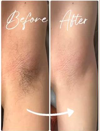 初脱毛
【照射2回目】
元々毛は細く少ないですが
2回でほぼ自己処理要らずです 