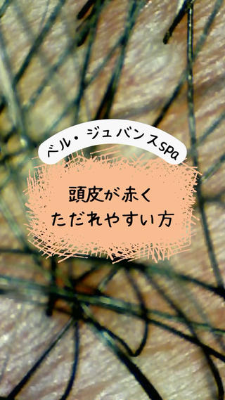 頭皮が痛痒い、乾燥にお悩みのお客様。
髪で隠れているので頭皮の肌荒れは放置されがちですが、髪の発育や体調に作用しますので早い対応が必要です 