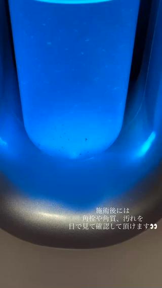 なかなかごっそり取れますそして取れた汚れを施術後見ることができるので実感が湧きます