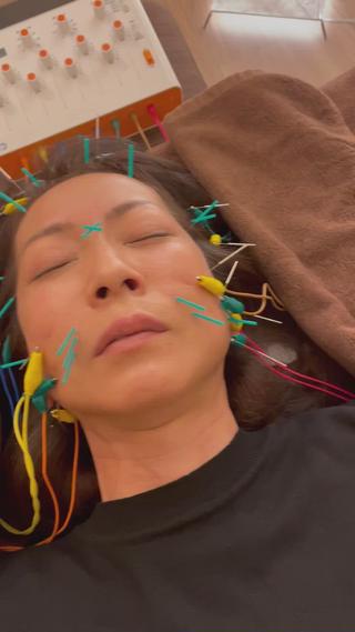 美容鍼スタンダードコースにオプションで電気鍼をつけました！ビフォーアフターがすごい！ 