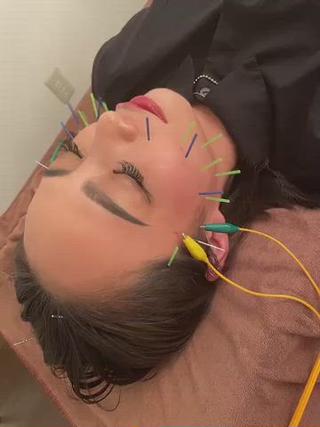 大人気の美容鍼の電気中です 