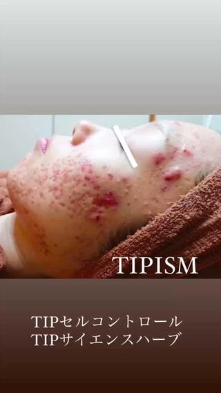 TIPハーブピーリングのbefore afterです
この肌質改善はハーブとプラセンタの力で
肌を根本的に甦らせます
〜TIPハーブピーリングの特徴〜
肌をこすって摩擦をかけません。
よくあるハーブピーリングは肌をこするなど
ハーブを肌に入れる際に摩擦が起こります。
その時に強い痛みも感じられる方も多いですが
摩擦レス。手の圧でハーブを毛穴入れ込みます。
痛みも抑えられハーブ経験者のお客様からは
痛みが違うと驚かれる方も多いです
ここまで肌が変わるTIPハーブ
凄いです
(株)三・一・五 症例より引用