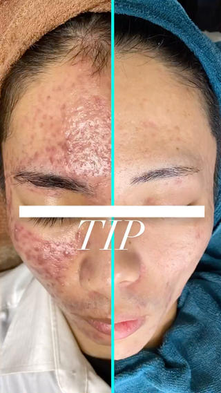 皮膚科学に基づいて開発された
TIPハーブピーリング
ドイツで育った有機ハーブにこだわり
13種類のハーブと高純度プラセンタが
弱った肌に行き届きます
当サロンでは専用マシンで毛穴を綺麗に洗浄後
お客様の肌に合わせハーブを調合し
独自の技術で毛穴から肌へ入れ込みます。
こちらの症例は
全て集中プログラムでの結果となります。
月に一度の施術
全てのスキンケア一式使用
TIPプラセンタカプセル内服
何をやっても改善しない。
そんなお悩みに終止符を打つ。
#TIPハーブピーリング
(株)三・一・五 症例より引用