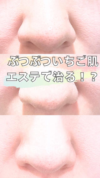 毛穴悩みに
あらゆるアプローチで施術をさせていただきます。 