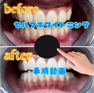 ホワイトニングの手順 